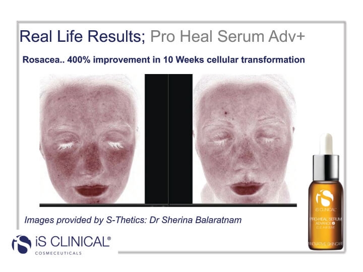 iS Clinical Pro-Heal Serum results (before and after image)