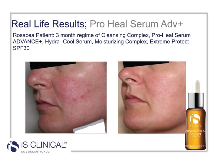 iS Clinical Pro-Heal Serum results (before and after client photo)