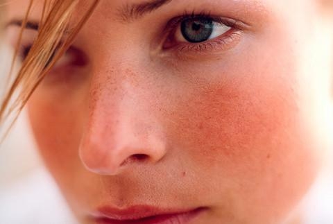 rosacea