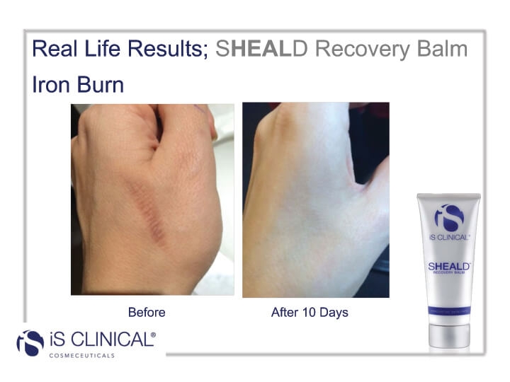 Before and After photos of using Sheald Recovery on iron burn