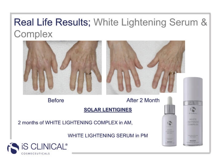 White Lightening Complex before and after image of hands