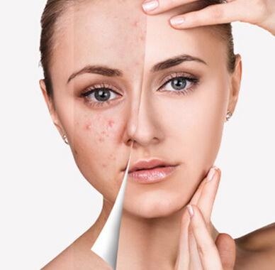 Acne Treatments Acne Treatments