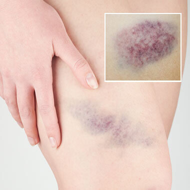 Bruise Relief Treatments Bruise Relief Treatments