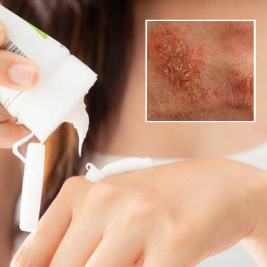 Eczema Eczema