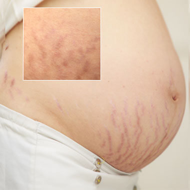Stretch Mark Treatments Stretch Mark Treatments