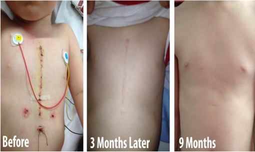 pro-sil-before-after-heart