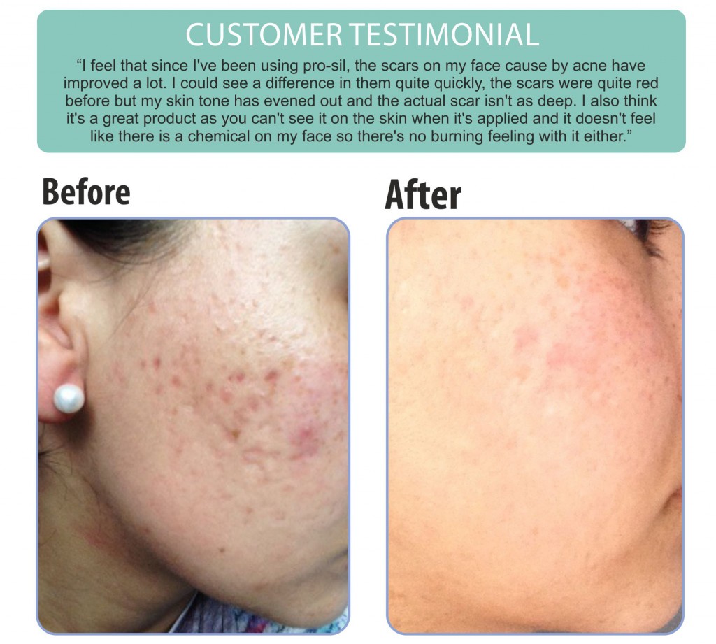 Amred before and after Acne Scar 2 Jpg (2)