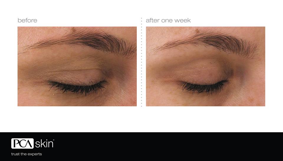BEFORE-AFTER