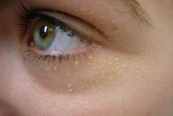under-eye-milia