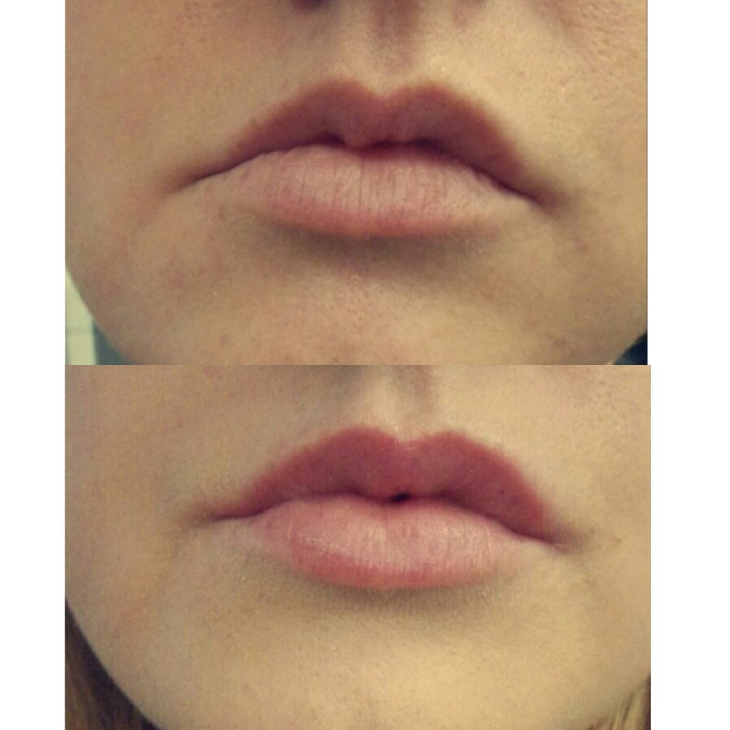 Try Mene & Moy Yellow Peel for fuller and plumper Lips Dermacare