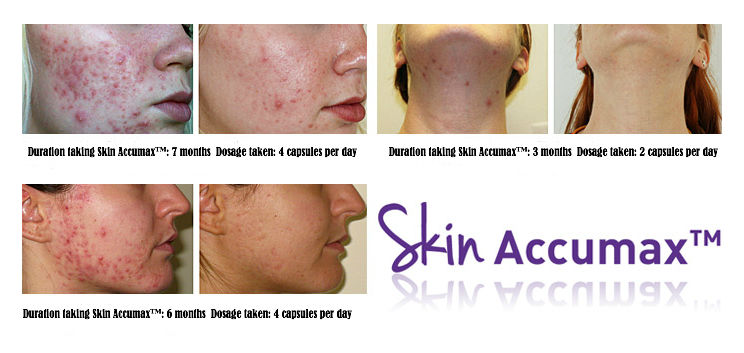 accumax-before-and-after-by_cosmeticsbay
