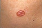Image of Basal Cell Carcinoma (BCC)