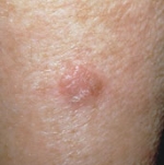 Image of Squamous Cell Carcinoma (SCC)