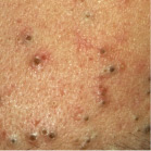 Blackheads - Acne