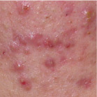 Papules - Acne