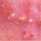 Pustules - Acne