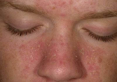 Close up of seborrhoeic dermatitis sufferer