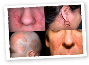 Pictures of seborrhoeic dermatitis sufferers