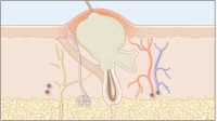 Spot inflammation and swelling