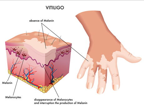 Image of skin structure of vitiligo sufferer