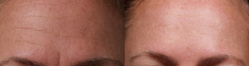 before and after brow image