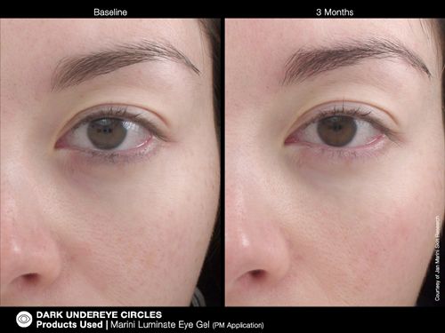 jan Marini Luminate Eye Ge before and after