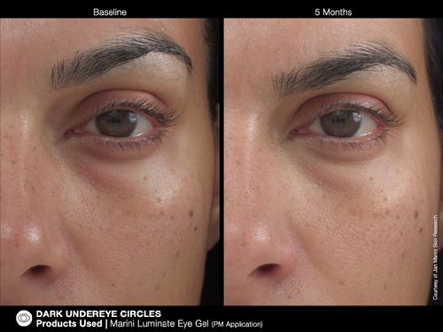 jan Marini Luminate Eye Ge before and after