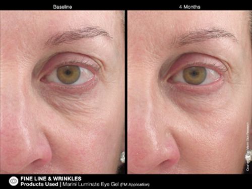 jan Marini Luminate Eye Ge before and after
