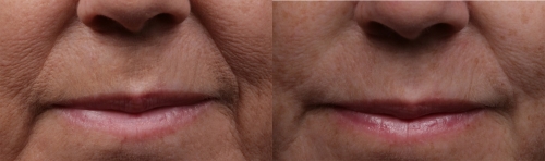before and after mouth image