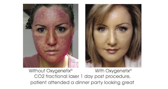 oxygenetix before and after