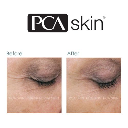pca rej serum before and after image